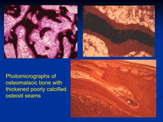 Photomicrographs of
osteomalacic bone with
thickened poorly calcified
osteoid seams
 