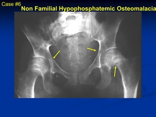 Case #6
          Non Familial Hypophosphatemic Osteomalacia
 