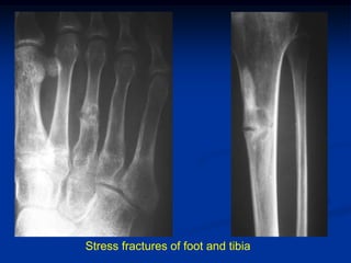 Stress fractures of foot and tibia
 