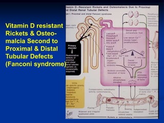 Vitamin D resistant
Rickets & Osteo-
malcia Second to
Proximal & Distal
Tubular Defects
(Fanconi syndrome)
 