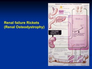 Renal failure Rickets
(Renal Osteodystrophy)
 