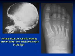 Normal skull but rachitic looking
growth plates and short phalanges
           in the foot
 