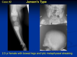 Case #2              Jansen’s Type




2.5 yr female with bowed legs and lytic metaphyseal streaking
 