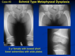 Case #3       Schmid Type Metaphyseal Dysplasia




     3 yr female with bowed short
  lower extremities with wide plates
 