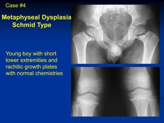 Case #4

Metaphyseal Dysplasia
   Schmid Type



 Young boy with short
 lower extremities and
 rachitic growth plates
 with normal chemistries
 