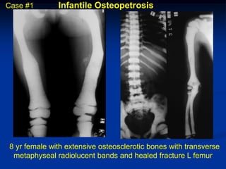 Case #1       Infantile Osteopetrosis




8 yr female with extensive osteosclerotic bones with transverse
 metaphyseal radiolucent bands and healed fracture L femur
 