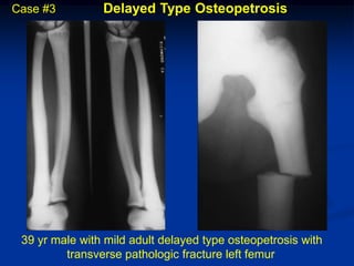 Case #3         Delayed Type Osteopetrosis




 39 yr male with mild adult delayed type osteopetrosis with
         transverse pathologic fracture left femur
 