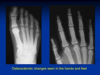 Osteosclerotic changes seen in the hands and feet
 