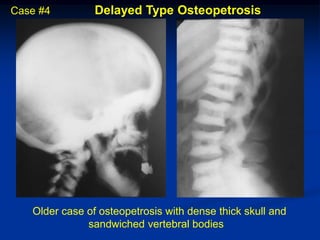 Case #4         Delayed Type Osteopetrosis




   Older case of osteopetrosis with dense thick skull and
              sandwiched vertebral bodies
 