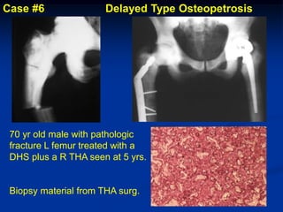 Case #6                Delayed Type Osteopetrosis




 70 yr old male with pathologic
 fracture L femur treated with a
 DHS plus a R THA seen at 5 yrs.


 Biopsy material from THA surg.
 