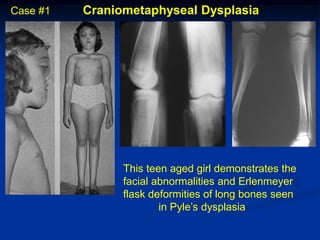 Case #1   Craniometaphyseal Dysplasia




                This teen aged girl demonstrates the
                facial abnormalities and Erlenmeyer
                flask deformities of long bones seen
                        in Pyle’s dysplasia
 