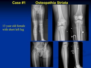 Case #1       Osteopathia Striata




13 year old female
with short left leg
 