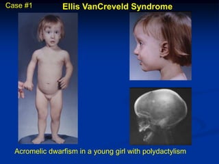 Case #1         Ellis VanCreveld Syndrome




  Acromelic dwarfism in a young girl with polydactylism
 