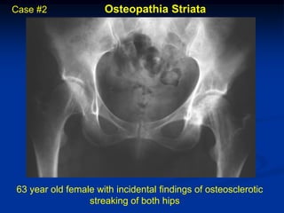 Case #2              Osteopathia Striata




63 year old female with incidental findings of osteosclerotic
                 streaking of both hips
 