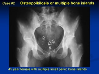 Case #2    Osteopoikilosis or multiple bone islands




   45 year female with multiple small pelvic bone islands
 