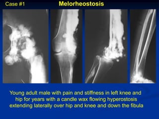 Case #1              Melorheostosis




 Young adult male with pain and stiffness in left knee and
   hip for years with a candle wax flowing hyperostosis
 extending laterally over hip and knee and down the fibula
 