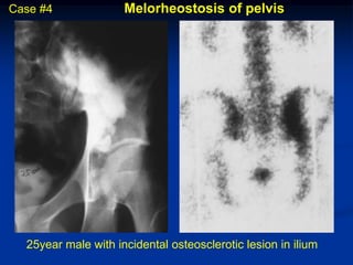 Case #4              Melorheostosis of pelvis




  25year male with incidental osteosclerotic lesion in ilium
 