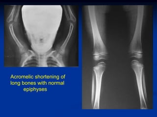 Acromelic shortening of
long bones with normal
      epiphyses
 