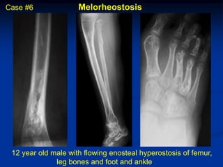 Case #6              Melorheostosis




 12 year old male with flowing enosteal hyperostosis of femur,
              leg bones and foot and ankle
 
