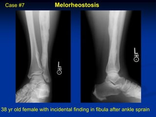 Case #7                Melorheostosis




38 yr old female with incidental finding in fibula after ankle sprain
 
