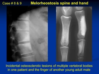 Case # 8 & 9       Melorheostosis spine and hand




  Incidental osteosclerotic lesions of multiple vertebral bodies
   in one patient and the finger of another young adult male
 