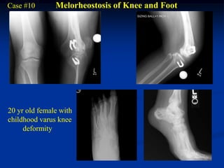 Case #10       Melorheostosis of Knee and Foot




20 yr old female with
childhood varus knee
     deformity
 