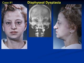 Case #1   Diaphyseal Dysplasia
 
