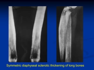 Symmetric diaphyseal sclerotic thickening of long bones
 
