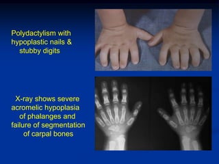 Polydactylism with
hypoplastic nails &
  stubby digits




 X-ray shows severe
acromelic hypoplasia
   of phalanges and
failure of segmentation
     of carpal bones
 