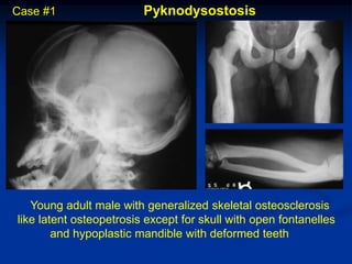 Case #1                  Pyknodysostosis




   Young adult male with generalized skeletal osteosclerosis
like latent osteopetrosis except for skull with open fontanelles
        and hypoplastic mandible with deformed teeth
 