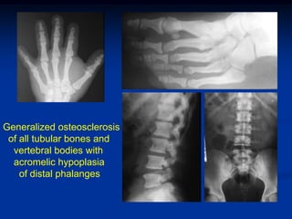 Generalized osteosclerosis
 of all tubular bones and
  vertebral bodies with
  acromelic hypoplasia
    of distal phalanges
 
