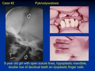 Case #2                Pyknodysostosis




 9 year old girl with open suture lines, hypoplastic mandible,
    double row of decidual teeth an dysplastic finger nails
 