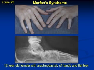 Case #3              Marfan’s Syndrome




 12 year old female with arachnodactyly of hands and flat feet
 