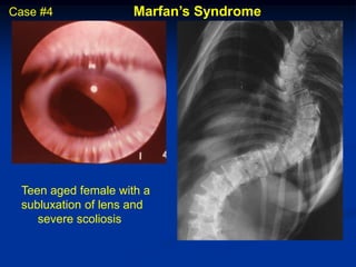 Case #4              Marfan’s Syndrome




 Teen aged female with a
 subluxation of lens and
    severe scoliosis
 