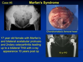 Case #5               Marfan’s Syndrome




                                     Chondromalacic femoral head

17 year old female with Marfan’s
and bilateral acetabular protrusio
and 2ndary osteoarthritis leading
up to a bilateral THA with x-ray
 appearance 10 years post op                   10 yr PO
 