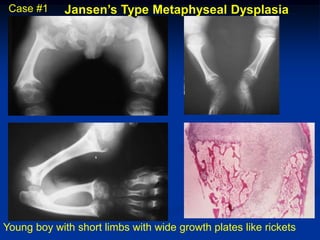 Case #1     Jansen’s Type Metaphyseal Dysplasia




Young boy with short limbs with wide growth plates like rickets
 