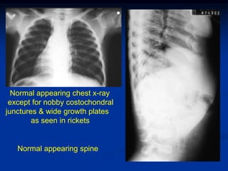 Normal appearing chest x-ray
 except for nobby costochondral
junctures & wide growth plates
        as seen in rickets


   Normal appearing spine
 