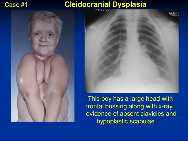 cleidocranial dysplasia