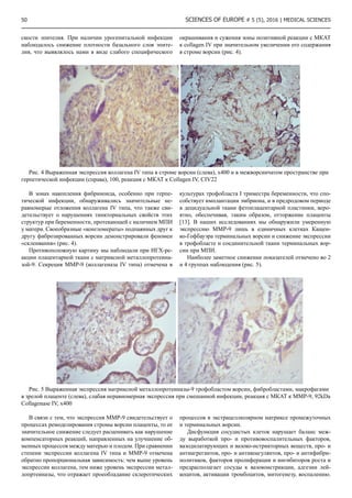 50 SCIENCES OF EUROPE # 5 (5), 2016 | Medical sciences
скости эпителия. При наличии урогенитальной инфекции
наблюдалось снижение плотности базального слоя эпите-
лия, что выявлялось нами в виде слабого специфического
окрашивания и сужения зоны позитивной реакции с МКАТ
к collagen IV при значительном увеличении его содержания
в строме ворсин (рис. 4).
Рис. 4 Выраженная экспрессия коллагена IV типа в строме ворсин (слева), х400 и в межворсинчатом пространстве при
герпетической инфекции (справа), 100, реакция с МКАТ к Сollagen IV, CIV22
В зонах накопления фибриноида, особенно при герпе-
тической инфекции, обнаруживались значительные не-
равномерые отложения коллагена IV типа, что также сви-
детельствует о нарушениях тинкториальных свойств этих
структур при беременности, протекающей с наличием МПИ
у матери. Своеобразные «конгломераты» подпаянных друг к
другу фиброзированных ворсин демонстрировали феномен
«склеивания» (рис. 4).
Противоположную картину мы наблюдали при ИГХ-ре-
акции плацентарной ткани с матриксной металлопротеина-
зой-9. Секреция MMP-9 (коллагеназа IV типа) отмечена в
культурах трофобласта I триместра беременности, что спо-
собствует имплантации эмбриона, и в предродовом периоде
в децидуальной ткани фетоплацентарной пластинки, веро-
ятно, обеспечивая, таким образом, отторжение плаценты
[13]. В наших исследованиях мы обнаружили умеренную
экспрессию ММР-9 лишь в единичных клетках Кащен-
ко-Гофбауэра терминальных ворсин и снижение экспрессии
в трофобласте и соединительной ткани терминальных вор-
син при МПИ.
Наиболее заметное снижение показателей отмечено во 2
и 4 группах наблюдения (рис. 5).
Рис. 5 Выраженная экспрессия матриксной металлопротеиназы-9 трофобластом ворсин, фибробластами, макрофагами
в зрелой плаценте (слева), слабая неравномерная экспрессия при смешанной инфекции, реакция с МКАТ к ММР-9, 92kDa
Collagenase IV, х400
В связи с тем, что экспрессия ММР-9 свидетельствует о
процессах ремоделирования стромы ворсин плаценты, то ее
значительное снижение следует расценивать как нарушение
компенсаторных реакций, направленных на улучшение об-
менных процессов между матерью и плодом. При сравнении
степени экспрессии коллагена IV типа и ММР-9 отмечена
обратно пропорциональная зависимость: чем выше уровень
экспрессии коллагена, тем ниже уровень экспрессии метал-
лопртеиназы, что отражает проеобладание склеротических
процессов в экстрацеллюлярном матриксе промежуточных
и терминальных ворсин.
Дисфункция сосудистых клеток нарушает баланс меж-
ду выработкой про- и противовоспалительных факторов,
вазодилатирующих и вазоко-нстрикторных веществ, про- и
антиагрегантов, про- и антикоагулянтов, про- и антифибри-
нолитиков, факторов пролиферации и ингибиторов роста и
предрасполагает сосуды к вазоконстрикции, адгезии лей-
коцитов, активации тромбоцитов, митогенезу, воспалению.
 