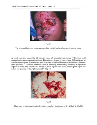 TOFIQ Journal of Medical Sciences, TJMS, Vol. 3, Issue 1, (2016), 1-16 12
Fig. 14
The primary blast wave impacts ruptured the eyeball and spalling out the orbital tissue.
A bomb blast may cause the full severity range of traumatic brain injury (TBI), from mild
concussion to severe, penetrating injury. The pathophysiology of blast-related TBI is distinctive,
with injury magnitude dependent on several factors, including blast energy and distance from the
blast epicenter. 19
TBI is an important cause of morbidity and mortality following a high-order
explosive event. The severity and nature of brain injuries that occur depend partly upon the
nature and quantity of the explosive used.20
Fig. 15
Fig. 15
Blast wave brain injury showing by brain coronal section (courtesy Dr. A Hadi Al Khalili)
 