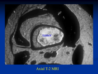 tumor




Axial T-2 MRI
 