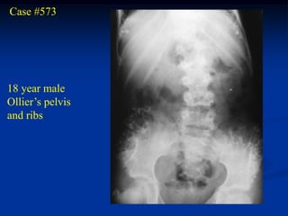 Case #573




18 year male
Ollier’s pelvis
and ribs
 