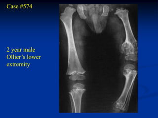 Case #574




2 year male
Ollier’s lower
extremity
 