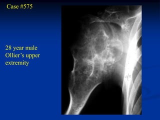 Case #575




28 year male
Ollier’s upper
extremity
 