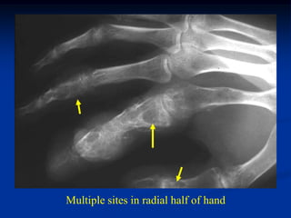 Multiple sites in radial half of hand
 