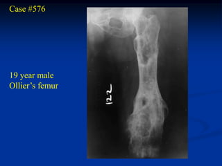 Case #576




19 year male
Ollier’s femur
 