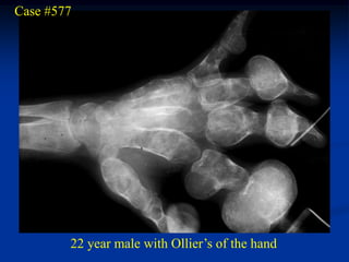 Case #577




        22 year male with Ollier’s of the hand
 