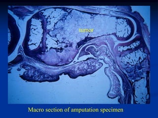 tumor




Macro section of amputation specimen
 