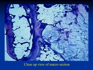 tumor




Close up view of macro section
 