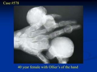 Case #578




        40 year female with Ollier’s of the hand
 